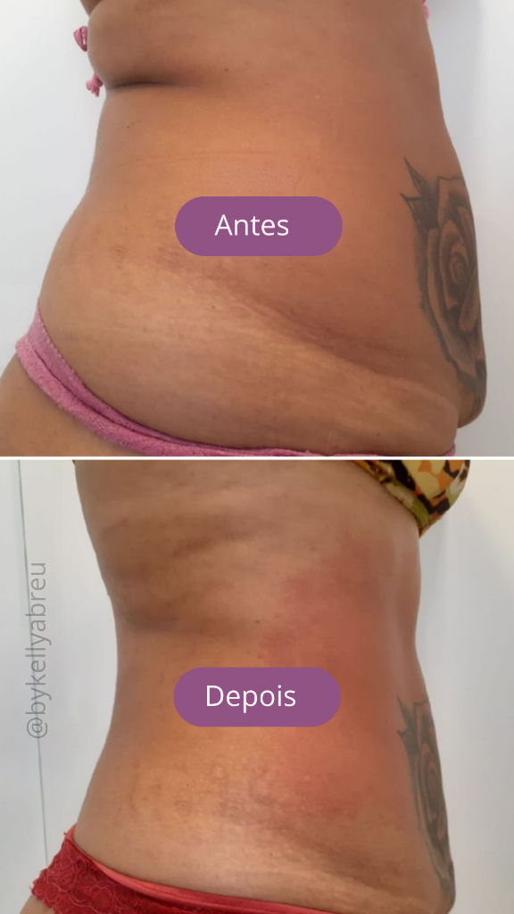Resultado Corporal 1