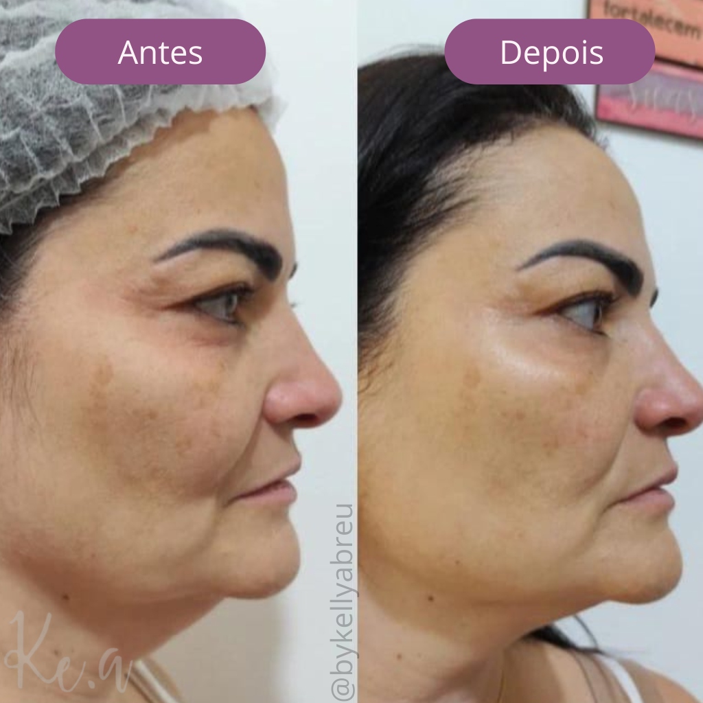 Resultado Facial 1