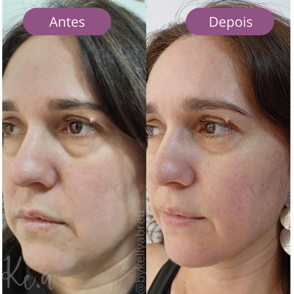 Resultado Facial 2