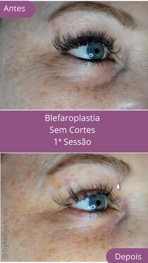 Blefaroplastia Result 2